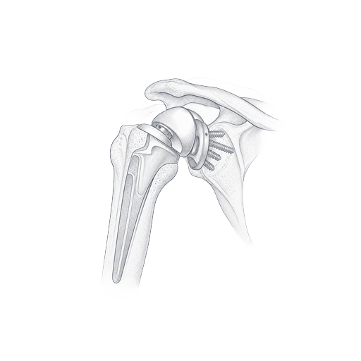 Revision shoulder arthroplasty illustration